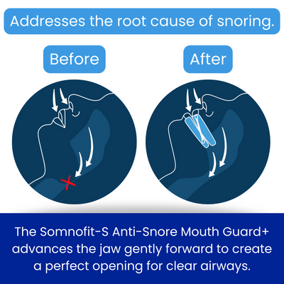 Somnofit-S addresses the root cause of snoring